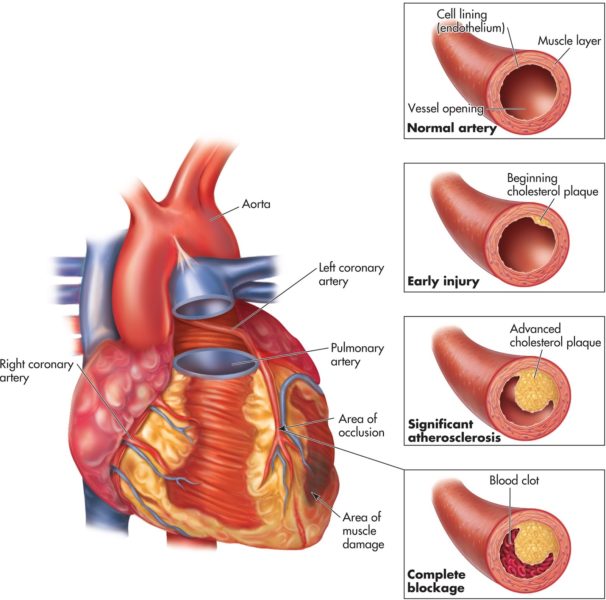 What is Atherosclerotic Heart Disease? Visit your cardiologist today.